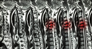 Spinal Cord Injuries from New York Trucking Accidents: New York City Personal Injury Lawyer Explains